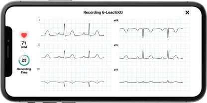KardiaMobile 6L Personal EKG Monitor  FDA-Cleared 6-Lead Heart Rhythm Tracker Compatible with Most Smartphones