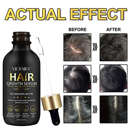 5% Minoxidil Biotin Serum for Hair Growth & Regrowth  2.02 oz  Natural Treatment for Thicker, Longer, Fuller Hair