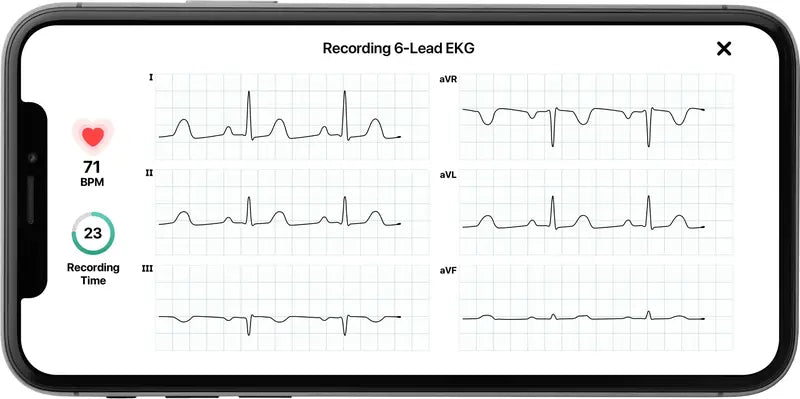 KardiaMobile 6L Personal EKG Monitor  FDA-Cleared, Compatible with Most Smartphones